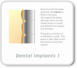 Dental Implants